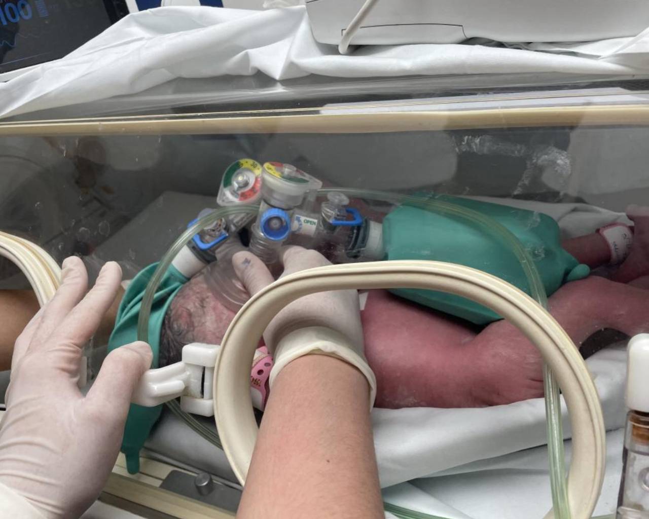 Separan a siamesas nacidas en el Hospital Regional Materno Infantil