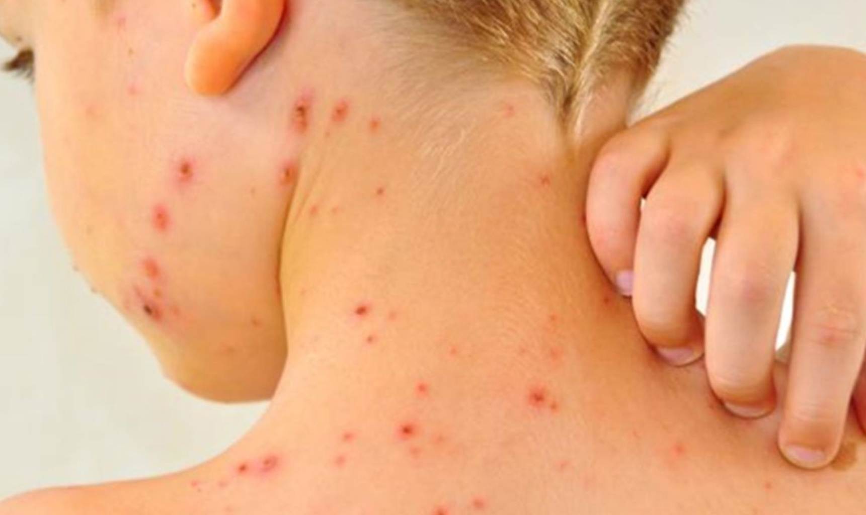 Sintomas del sarampion