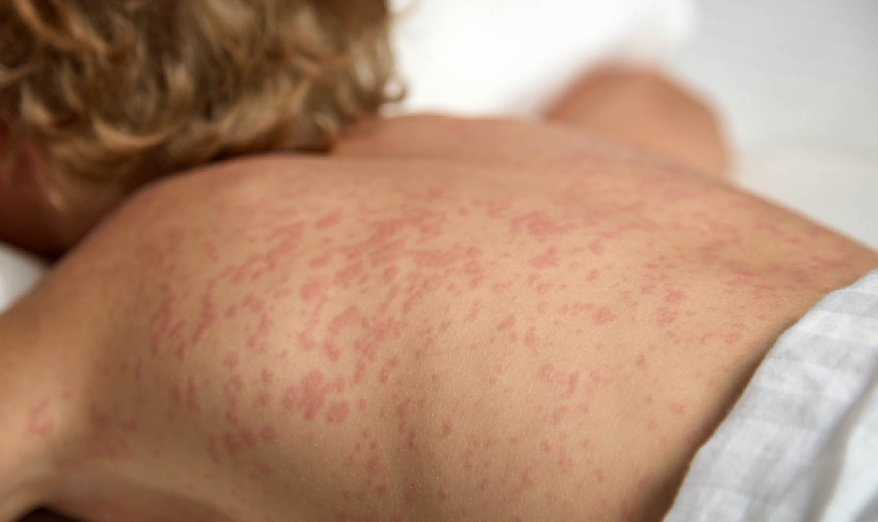 Complixcaciones del sarampion